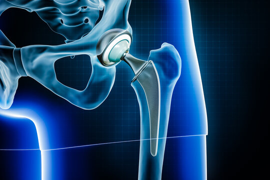 Dr. Sonawane performing hip replacement surgery at Dr. Sonawane's Hospital, Nerul Navi Mumbai
