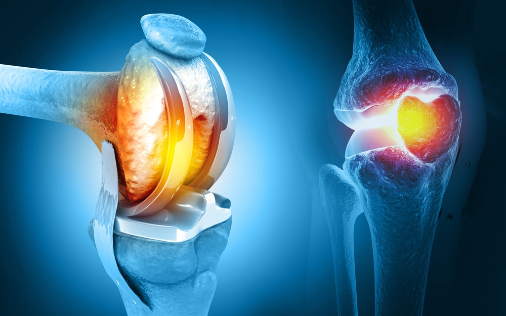 Knee Replacement Surgery at Dr. Sonawane's Hospital
